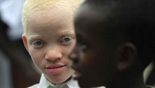 Голубоглазая блондинка родилась у темнокожей пары. Спустя 10 лет
