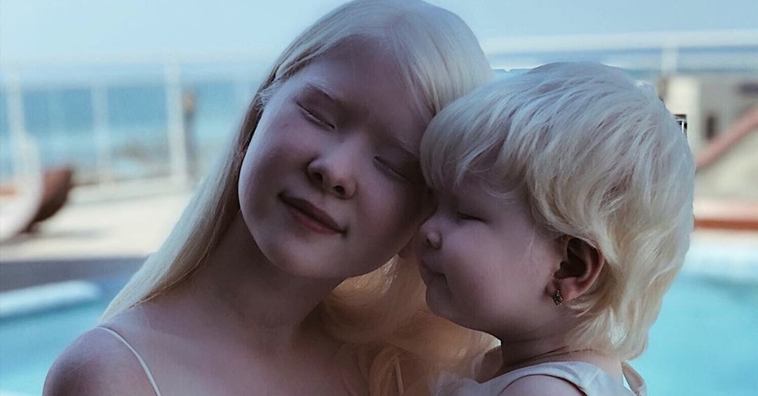 Сестрички-альбиносы из Казахстана — настоящее чудо!