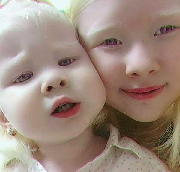 Сестрички-альбиносы из Казахстана — настоящее чудо!
